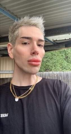 TÉMOIGNAGE  J’ai dépensé une fortune en chirurgie esthétique pour ressembler à la poupée Ken