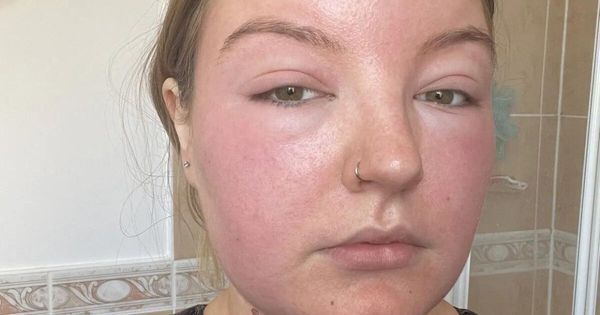 TÉMOIGNAGE  Mon visage a doublé de volume à cause d’un empoisonnement au soleil