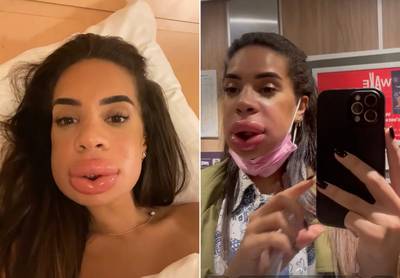 Une candidate de téléréalité défigurée après une injection aux lèvres: “J’ai frôlé la catastrophe”