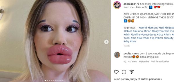 TÉMOIGNAGE  J’ai subi 32 opérations pour avoir les plus grosses lèvres au monde