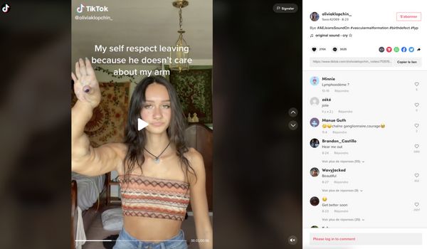 TÉMOIGNAGE  Je suis née avec un bras énorme et les gens me disent de l’amputer