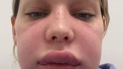 Ses injections dans les lèvres tournent mal et la laissent avec la tête d’un petit animal