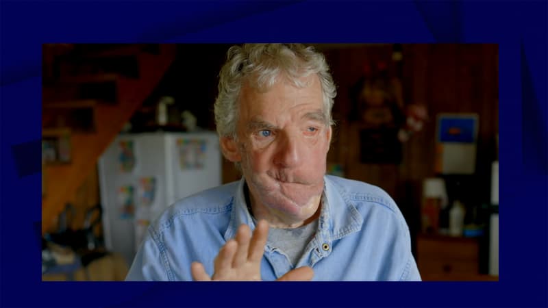 “J’ai senti ses dents”: un chasseur d’ours raconte l’attaque qui lui a coûté sa mâchoire et sa langue