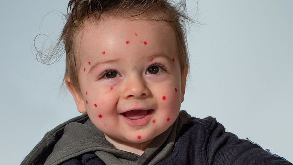 Une petite fille attrape la varicelle et bascule dans l’horreur