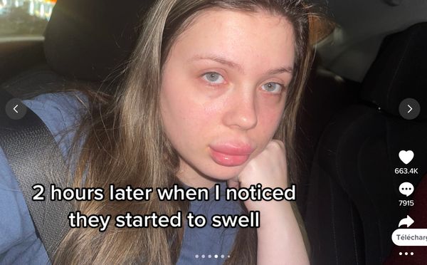 TÉMOIGNAGE  Défigurée par des injections aux lèvres je ne pouvais plus parler
