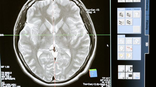 TÉMOIGNAGE. "J’ai éternué et mon cerveau a explosé"