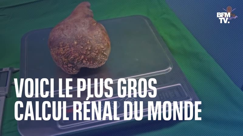 801 grammes, 13,37 cm… Le plus gros calcul rénal au monde retiré sur un retraité au Sri Lanka