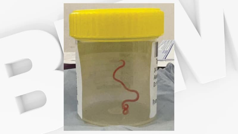 “Personne ne s’attendait à ça”: un ver vivant a été découvert dans le cerveau d’une Australienne