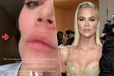 Khloé Kardashian partage des images de son visage transformé par un mélanome