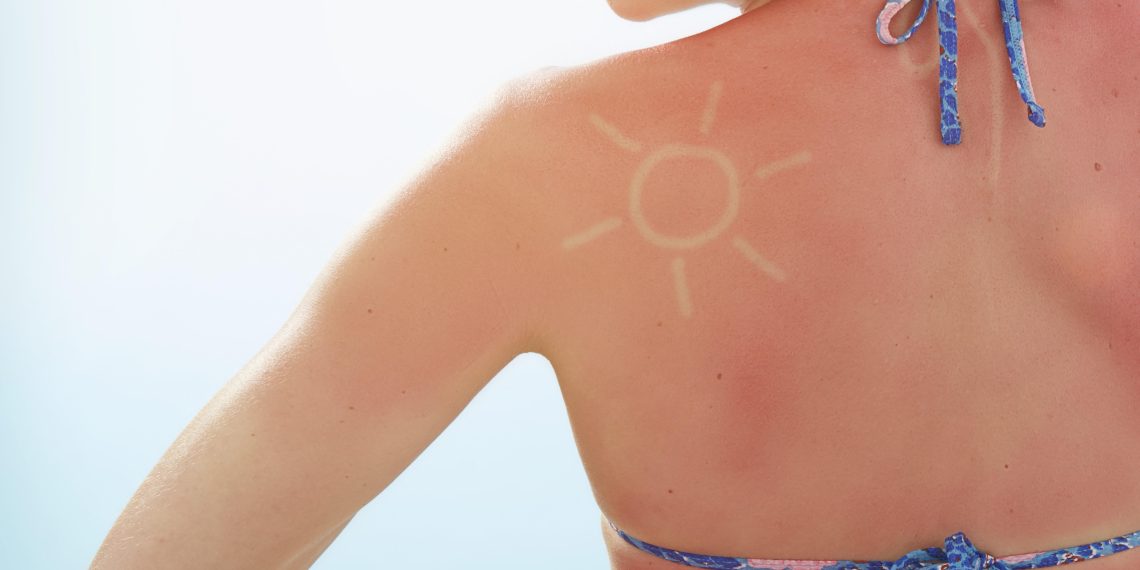 Qu’est-ce que la tendance dangereuse des «sun-tattoos» ?