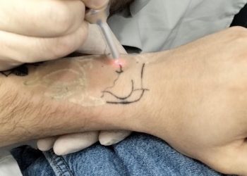 Quand l’encre devient un fardeau : la nouvelle tendance du détatouage