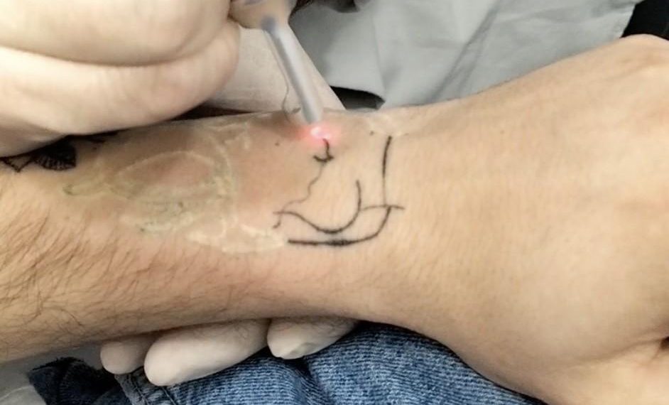 Quand l’encre devient un fardeau : la nouvelle tendance du détatouage